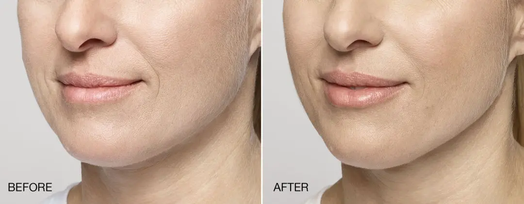 Lip Enhancement, Lip Fillers