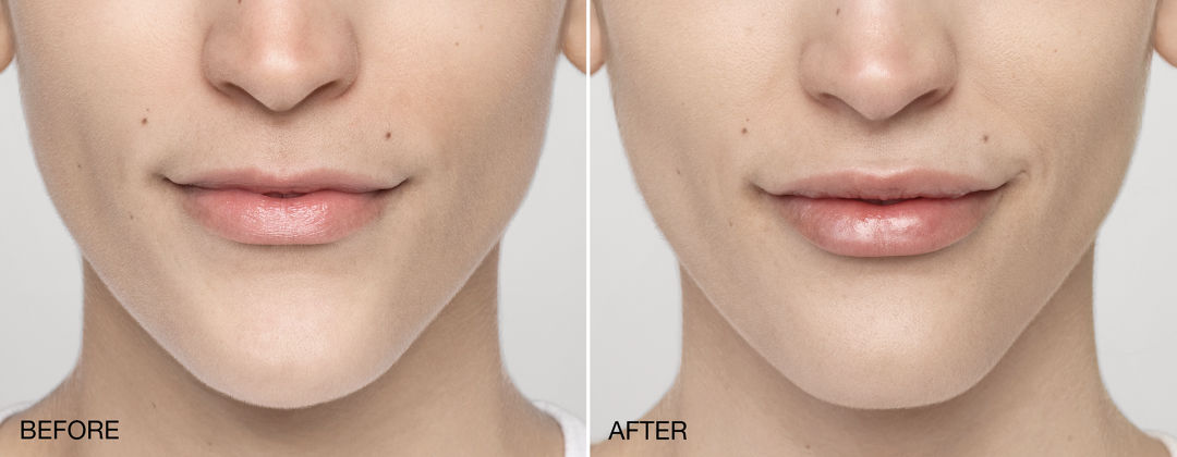 Lip Enhancement, Lip Fillers