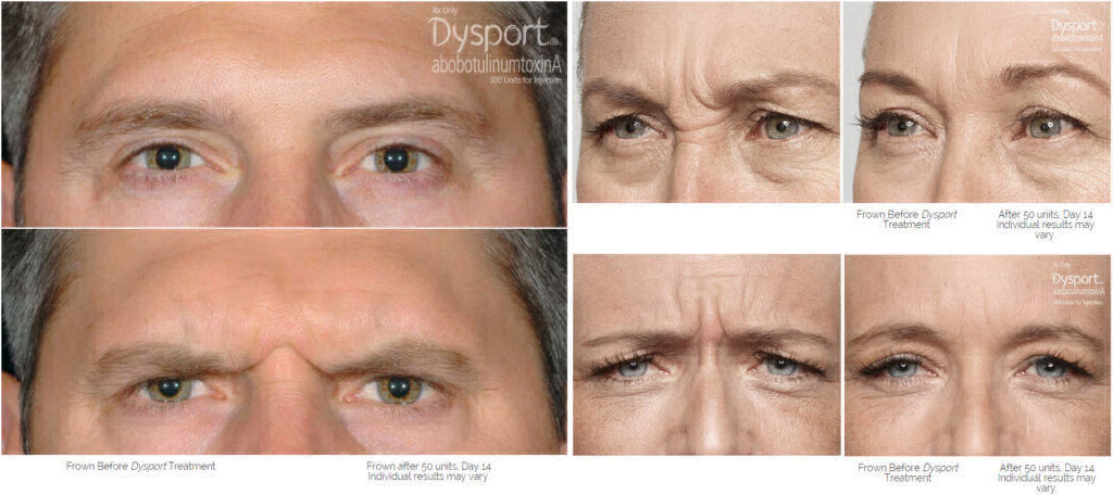 frown lines