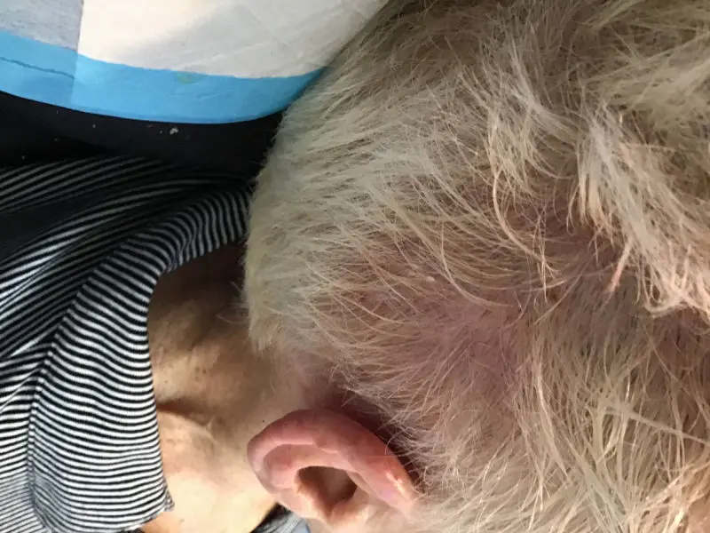 PRP Hair Restoration