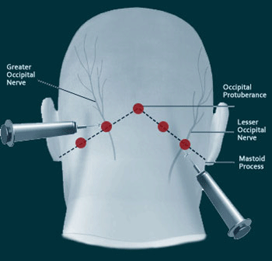 Occipital Nerve Blocks