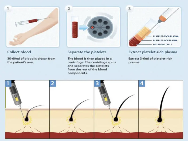 PRP Hair Restoration