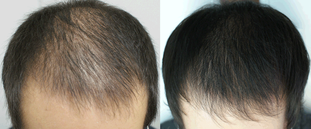 PRP Hair treatment