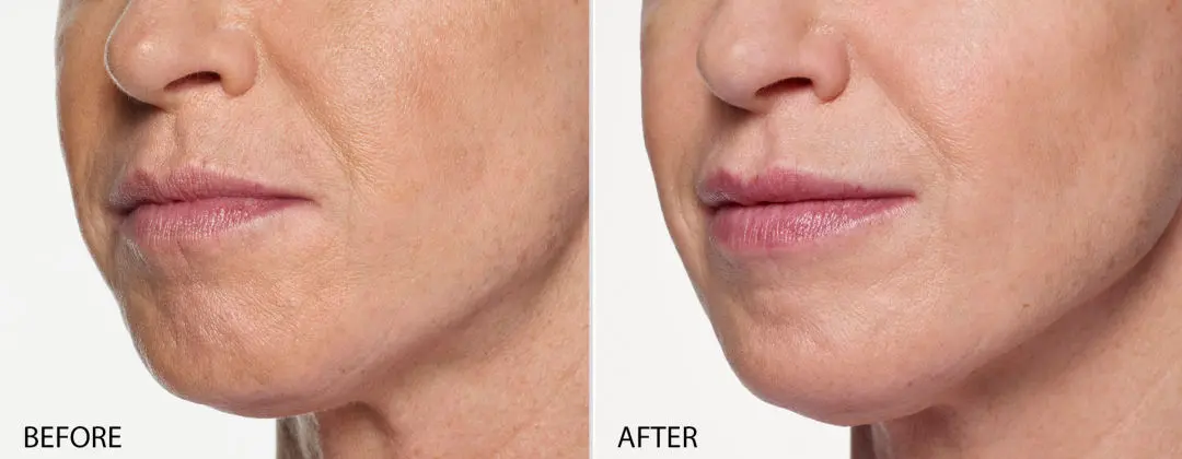 Lip Enhancement, Lip Fillers