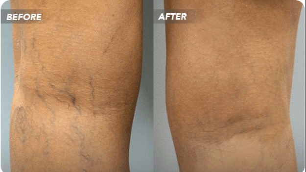 Spider Veins