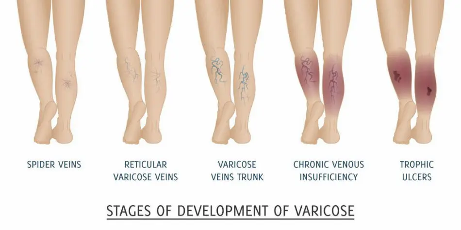 Varicose Vein